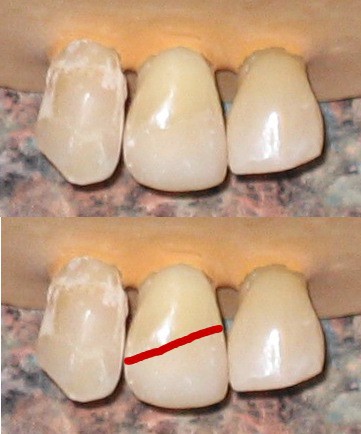 دندان لب پر شده به چه صورت با کامپوزیت دندان ترمیم میشود؟