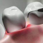 لیزر در دندان پزشکی