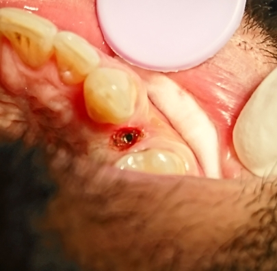 معایب و مزایای کاشت ایمپلنت دندان