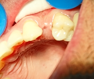 معایب و مزایای کاشت ایمپلنت دندان